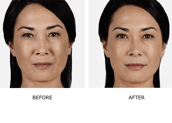 Juvéderm Treatment in Nairobi