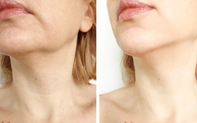 Morpheus8: Revolutionary Non-Surgical Facelift