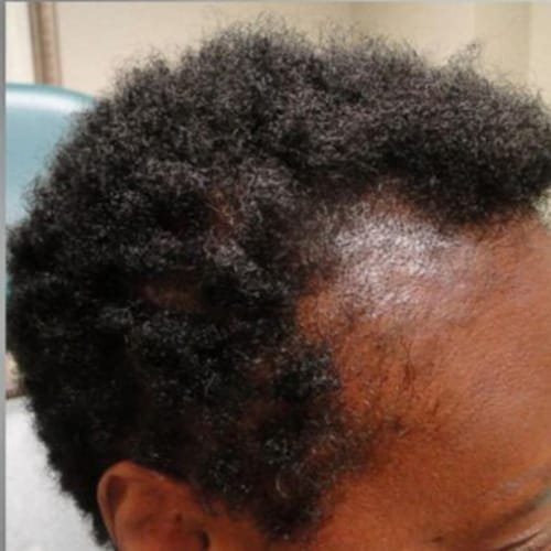 Hair Loss Treatment in Nairobi