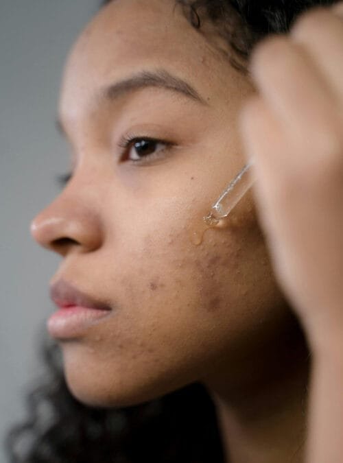 A Guide to Acne Solutions