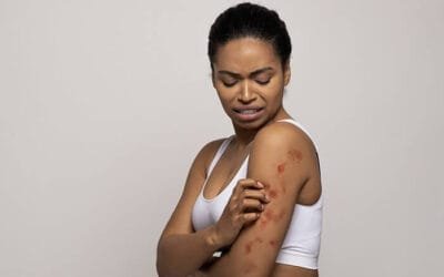 Eczema in Nairobi Kenya