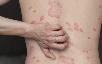 Psoriasis Treatment in Nairobi