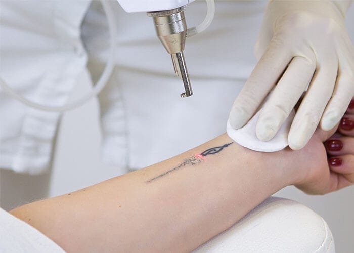 Tattoo removal in Nairobi