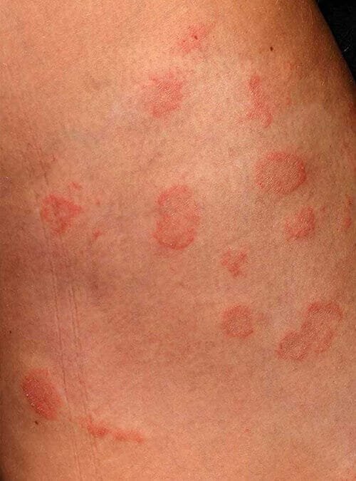 Body Fungal Infections Treatment