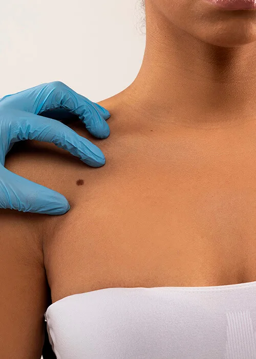 Cosmetic Mole Removal in Nairobi
