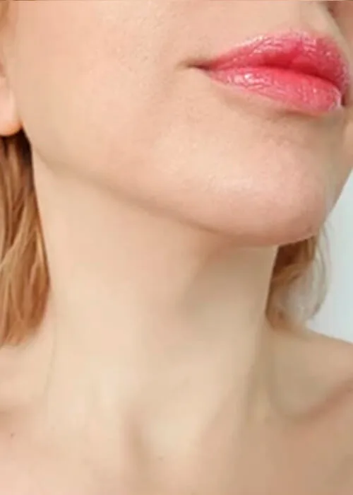 Threadlift Treatment in Nairobi