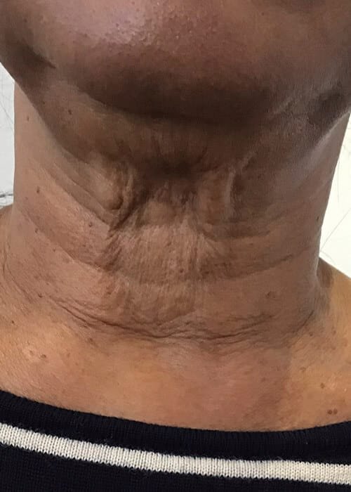 Necklines Treatment in Nairobi
