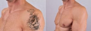 Pico laser tattoo removal in Nairobi, Kenya - Avane Dermatology Clinic