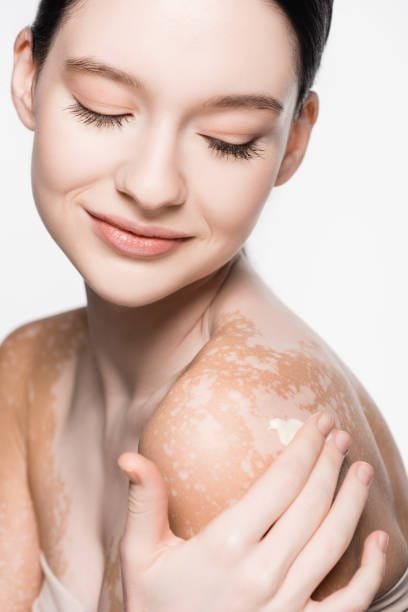 vitiligo laser treatment vitiligo laser treatment